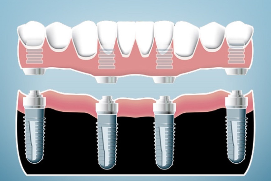 Impianti zigomatici3