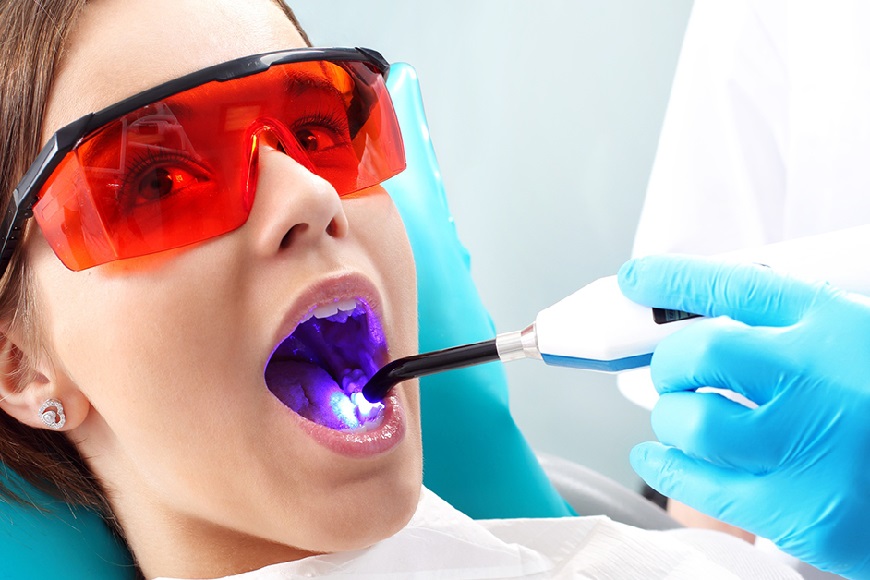 Materiali per otturazioni4